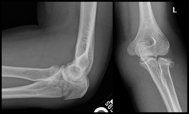 Olecranon and Radial Head ORIF pre-op 1