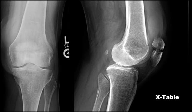 Patella ORIF pre-op 1