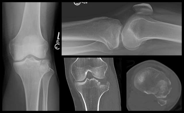Tibial Plateau ORIF pre-op 1