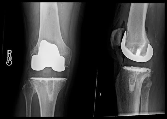 Total Knee Arthroplasty post-op 1