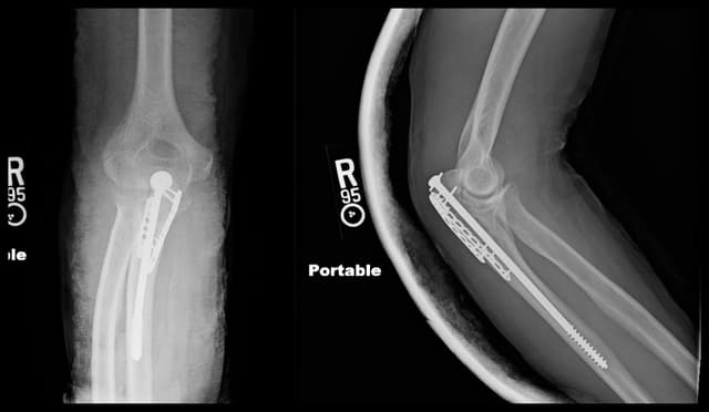 Olecranon ORIF post-op 1