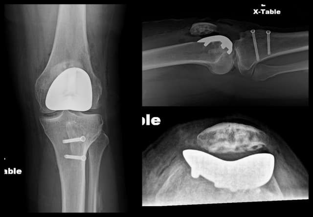 Patellofemoral Arthroplasty post-op 1