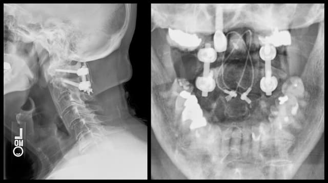 C1-2 Fusion post-op 2
