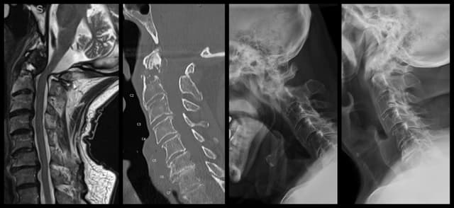 C1-2 Fusion post-op 1