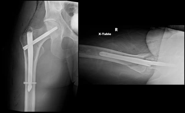 Intertrochanteric Fracture Short Nail post-op 1