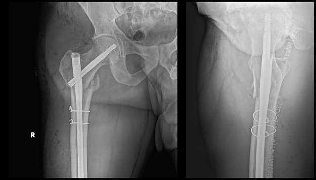 Subtrochanteric Femur ORIF post-op 1