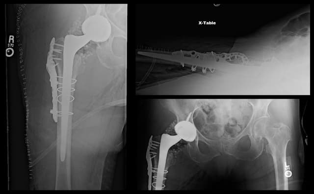 Periprosthetic Femur Fracture ORIF, Stem Revision post-op 1