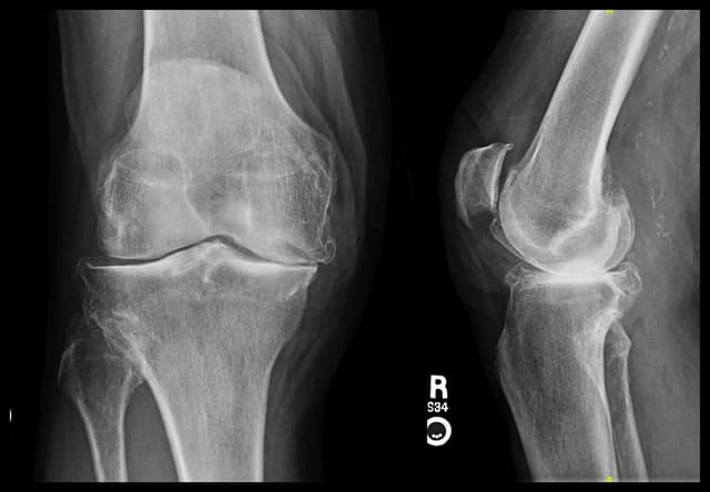 Total Knee Arthroplasty pre-op 1