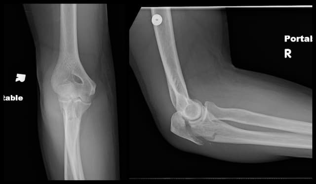 Olecranon ORIF pre-op 1