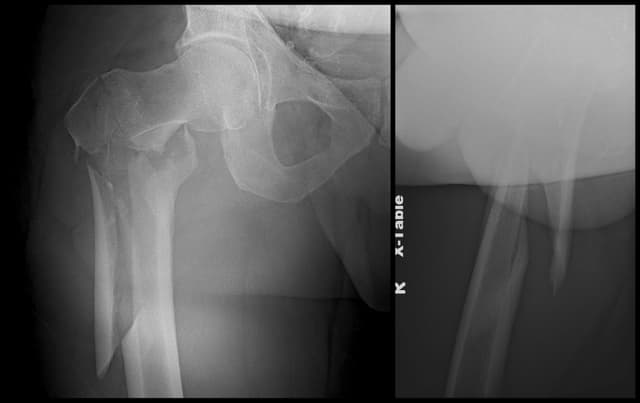 Subtrochanteric Femur ORIF pre-op 1