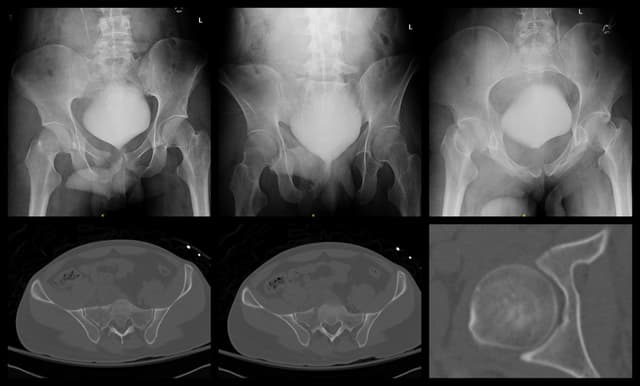 Pelvic Ring Fixation pre-op 1