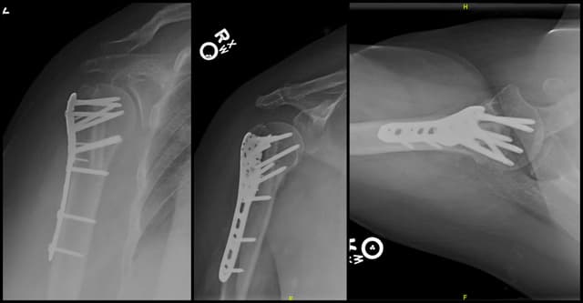 Proximal Humerus ORIF post-op 1