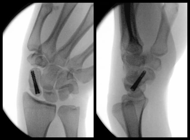 Scaphoid Fracture Fixation post-op 1