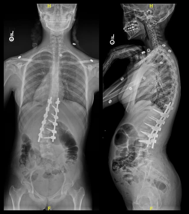 Posterior Spinal Fusion for Scoliosis post-op 1