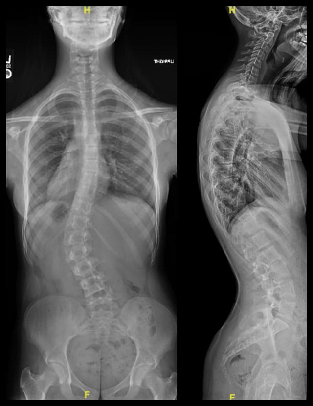 Posterior Spinal Fusion for Scoliosis pre-op 1