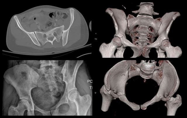Posterior Sacroiliac Joint Fixation pre-op 1