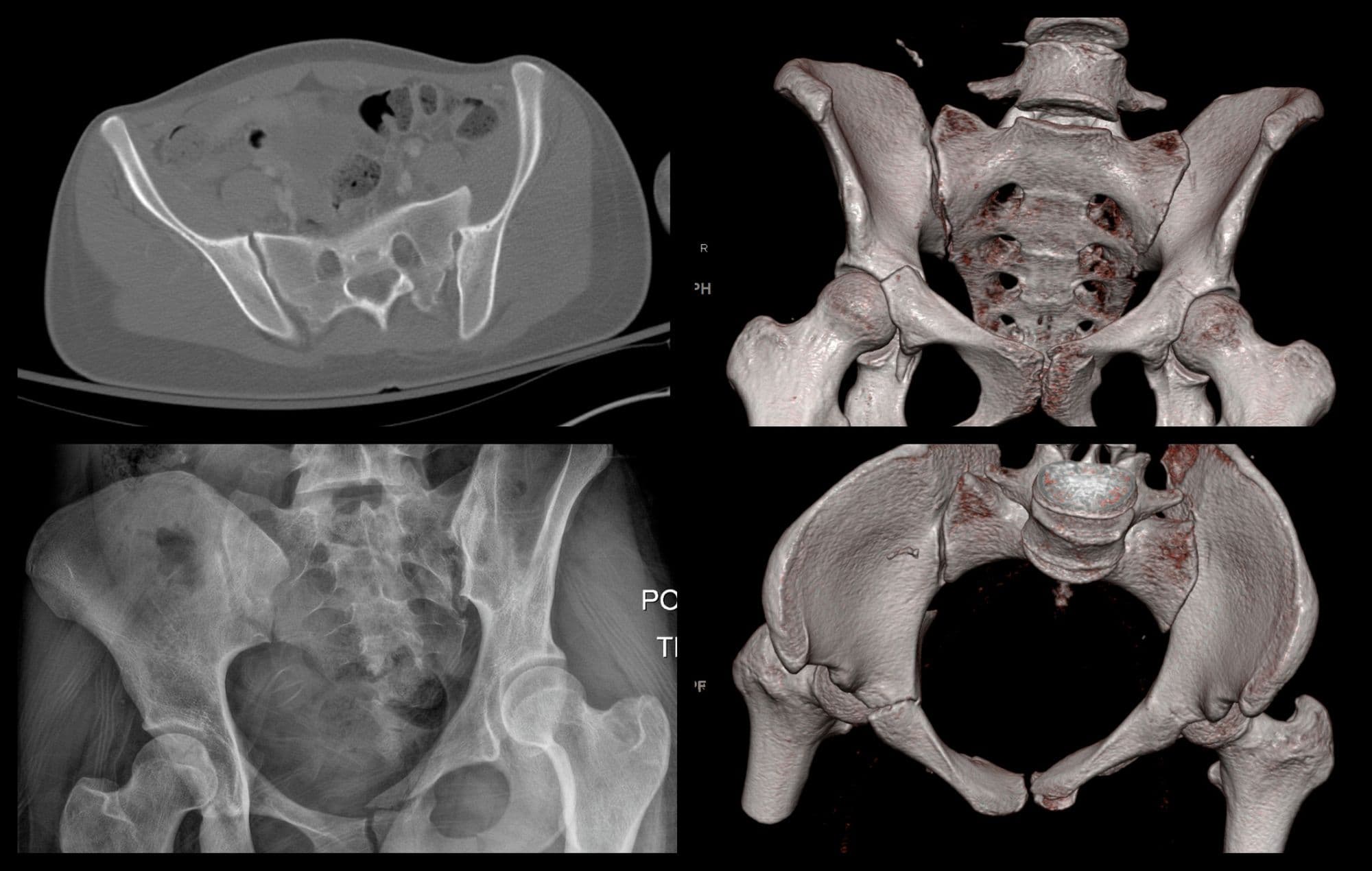 Posterior Sacroiliac Joint Fixation