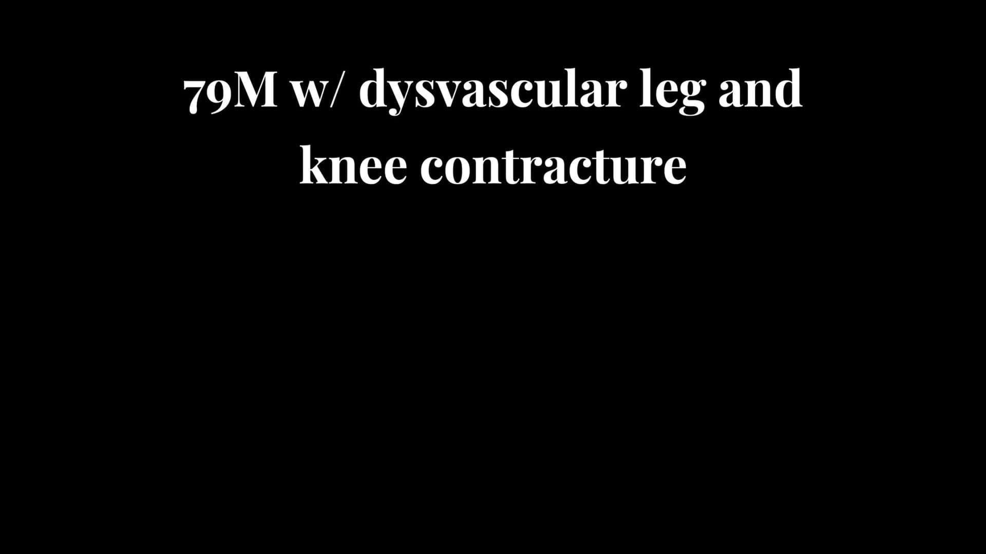 Above Knee Amputation