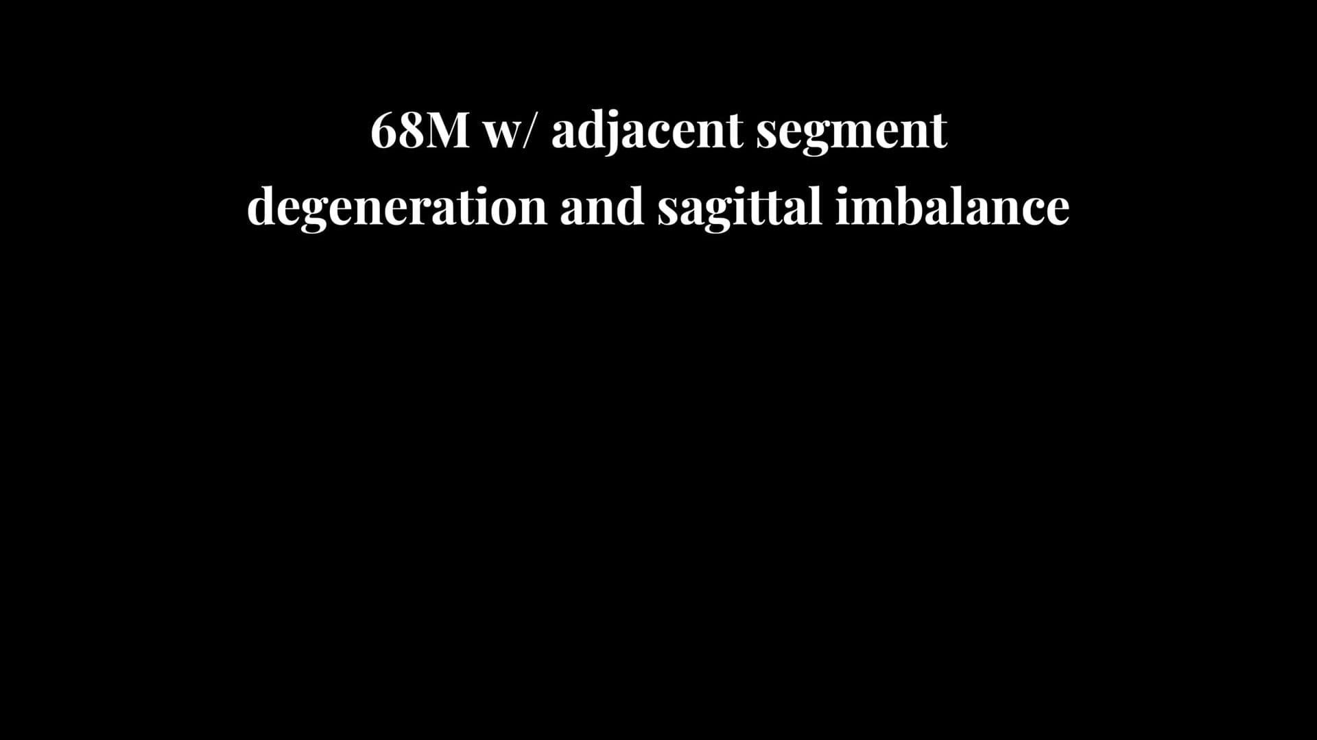 L5-S1 Anterior lumbar interbody fusion
