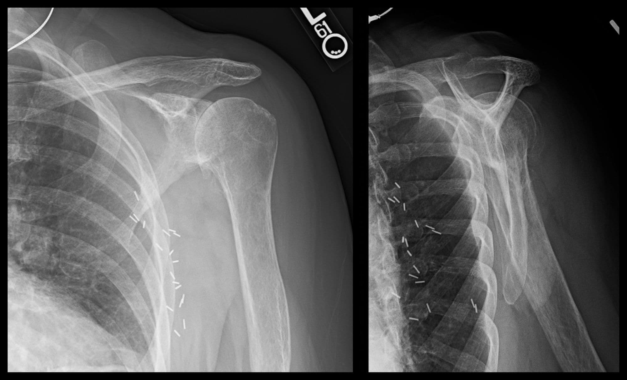 Reverse Shoulder Arthroplasty