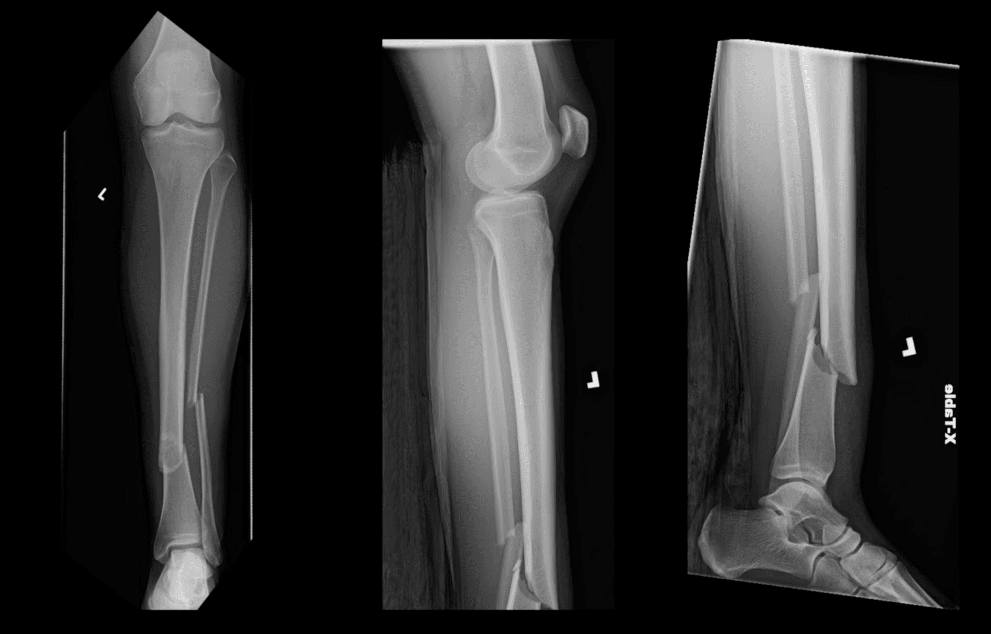 Distal Tibia IMN