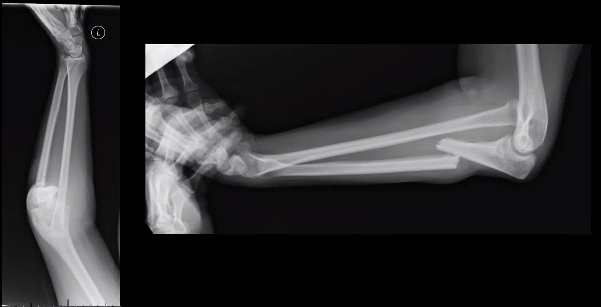 Monteggia Fracture ORIF