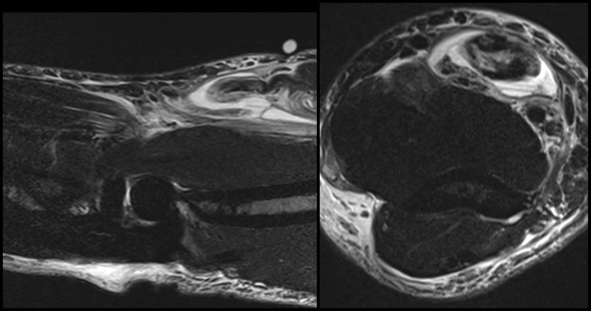 Distal Biceps Repair
