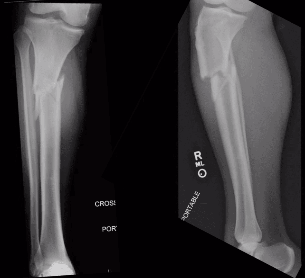 Proximal Tibia IMN
