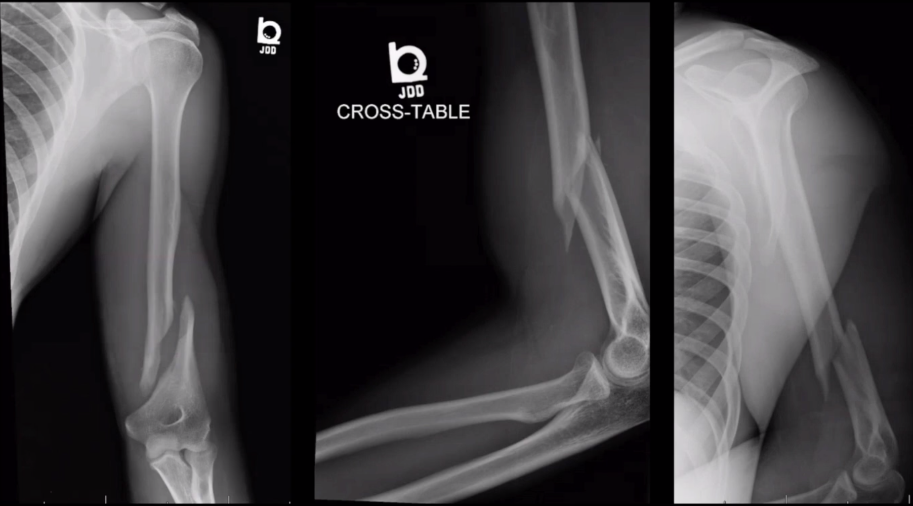 Distal Humerus ORIF
