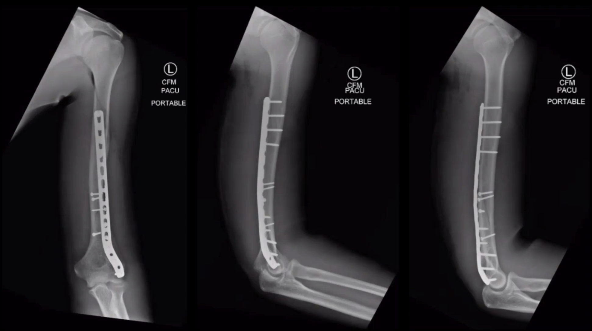 Distal Humerus ORIF