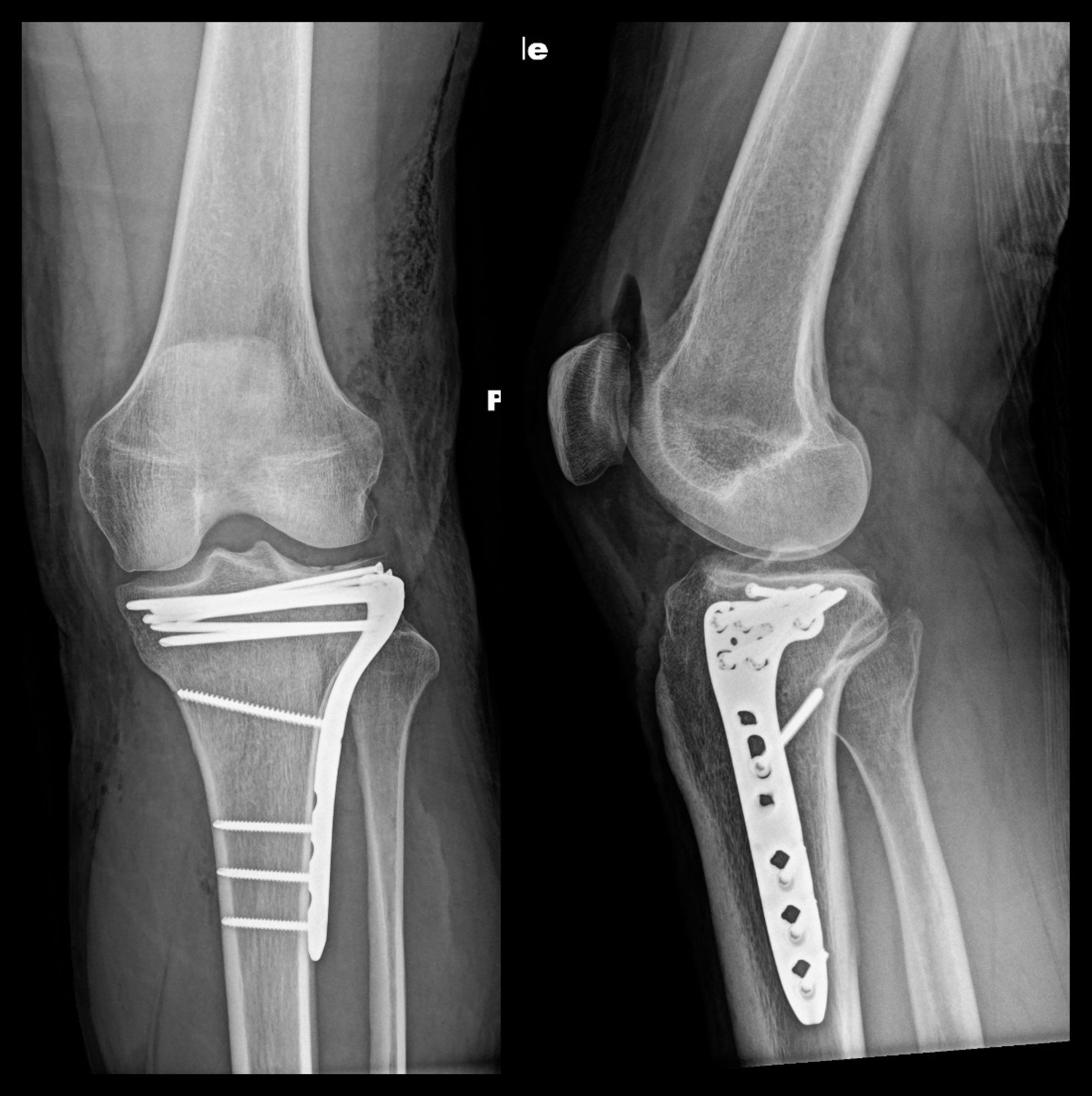 Ap Radiograph Of A Medial Tibial Plateau Fracture Tre