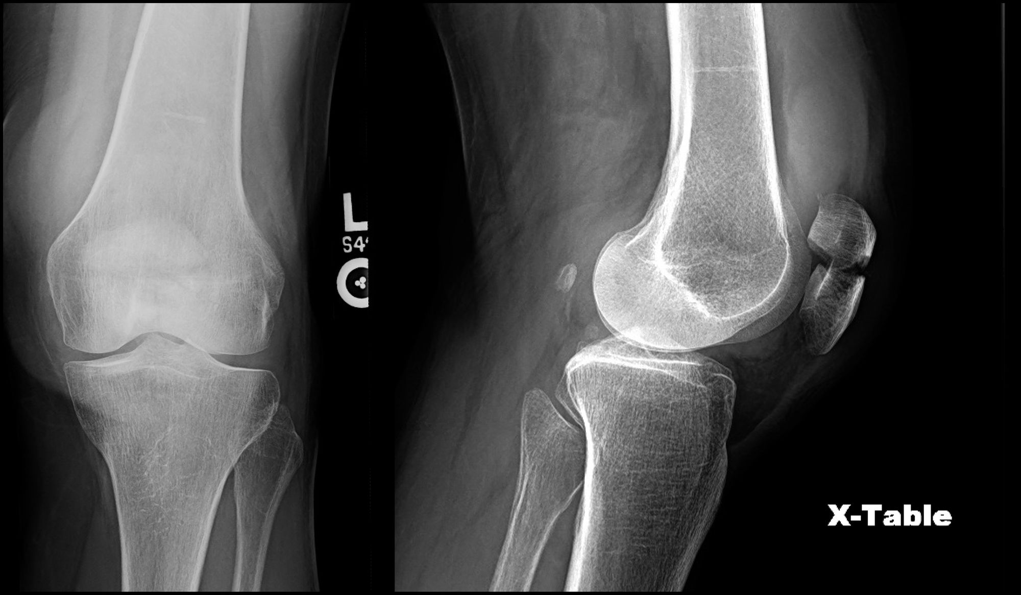 Patella ORIF
