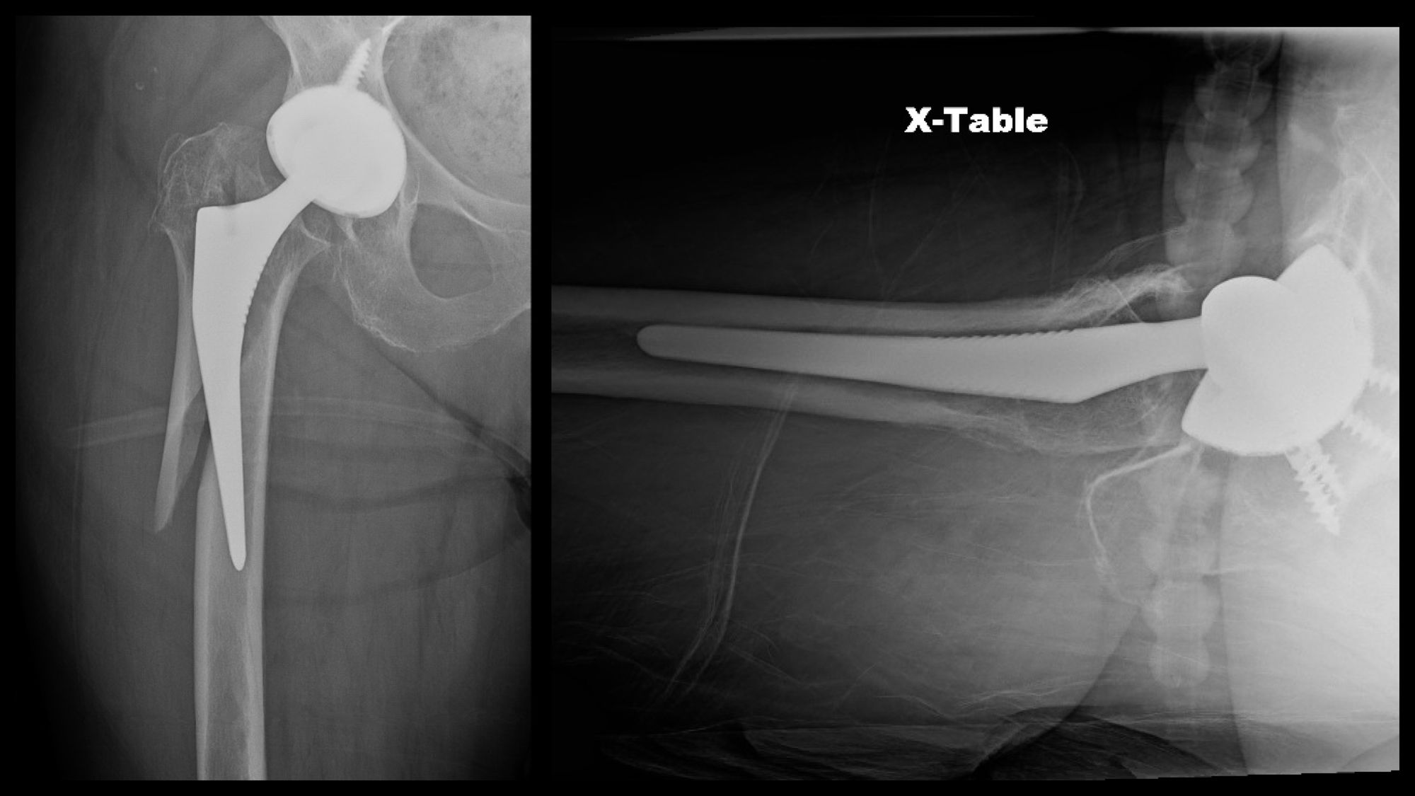 icd 10 code for status post orif right femur fracture