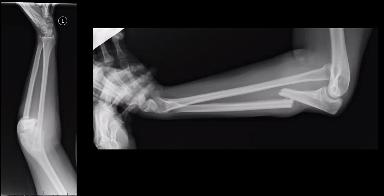 Monteggia Fracture ORIF