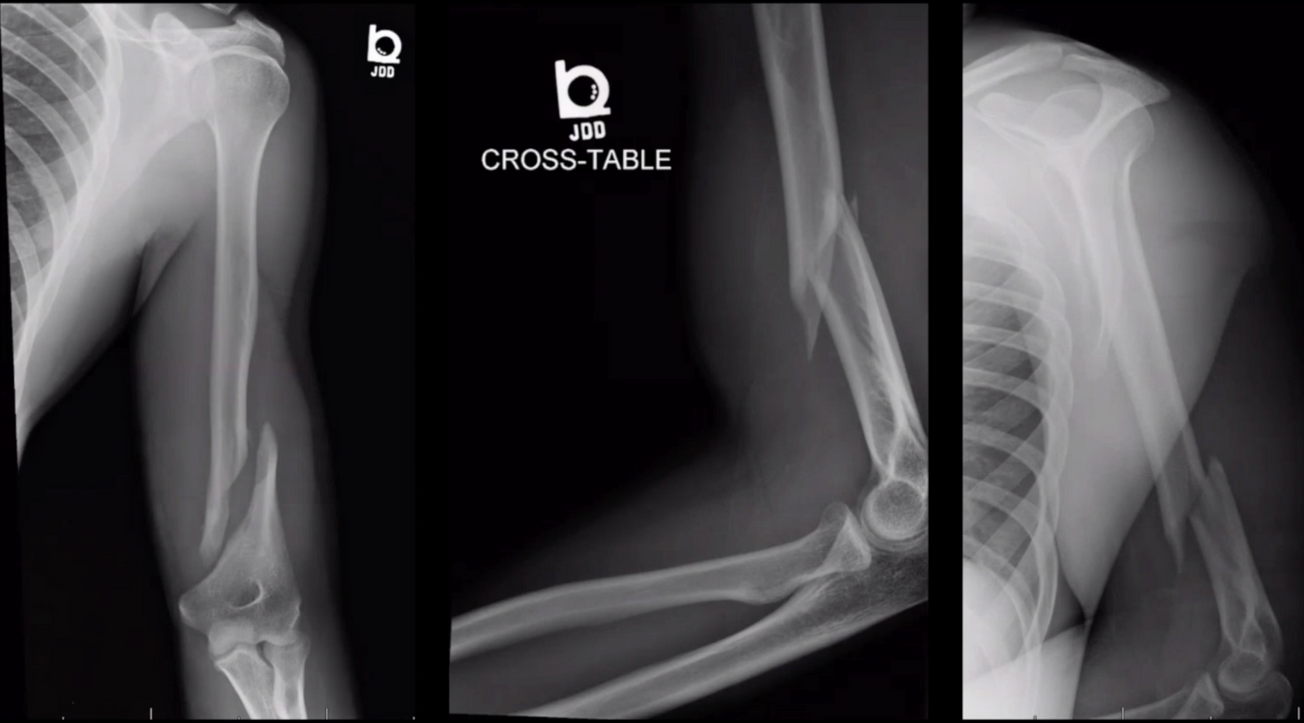 Distal Humerus ORIF