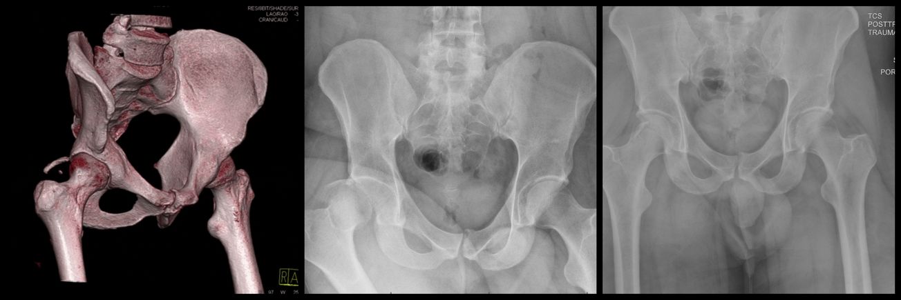 Posterior Wall Acetabulum ORIF