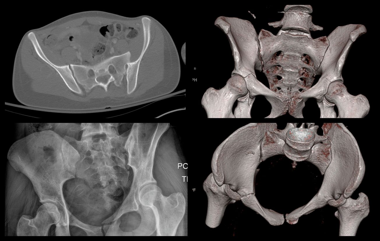 Posterior Sacroiliac Joint Fixation