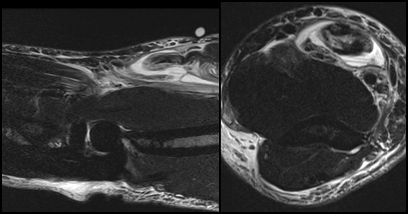 Distal Biceps Repair