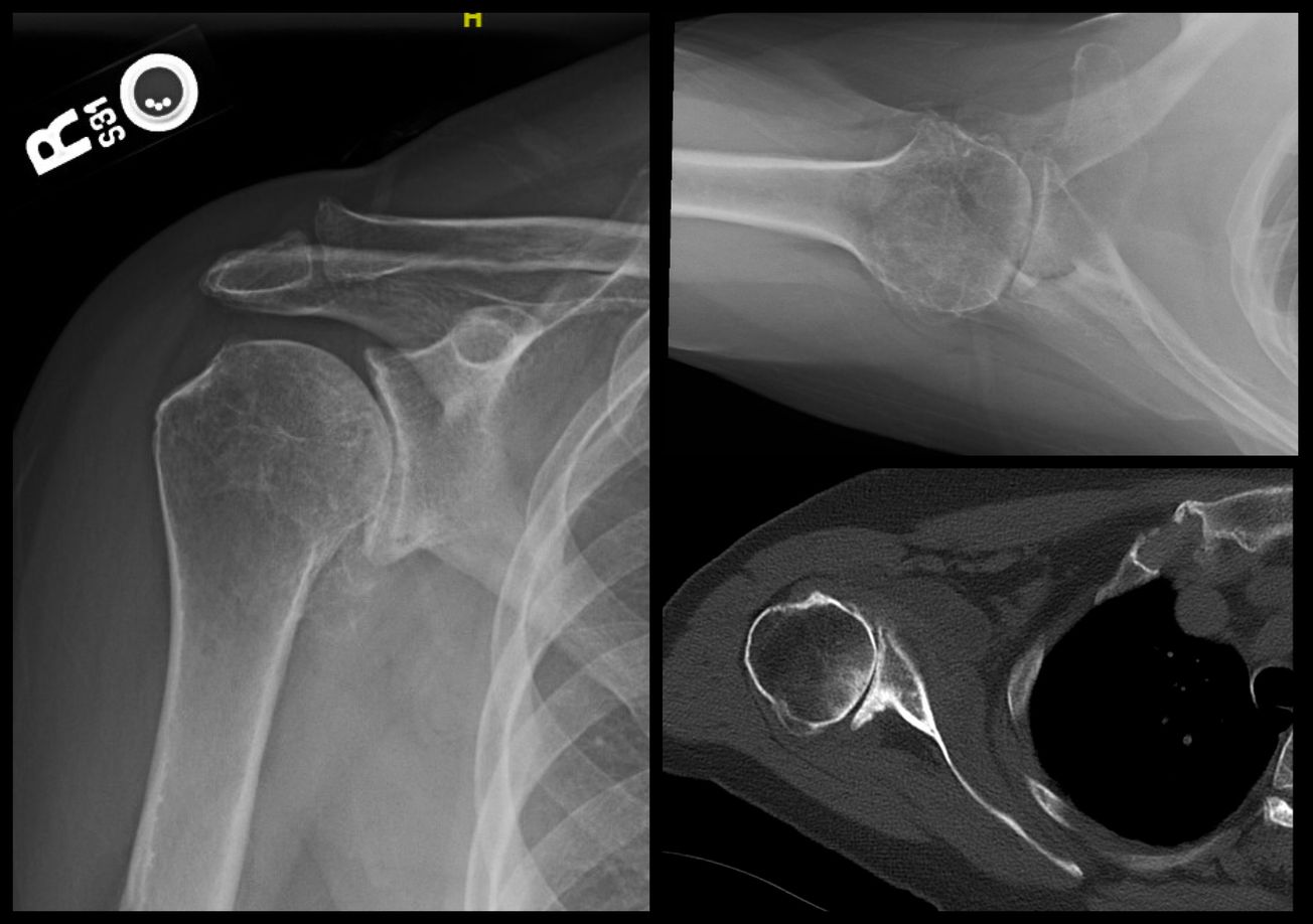 Reverse Shoulder Arthroplasty (patient-specific guide)