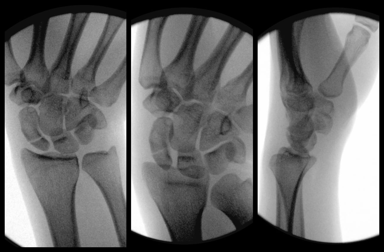 Scaphoid Fracture Fixation