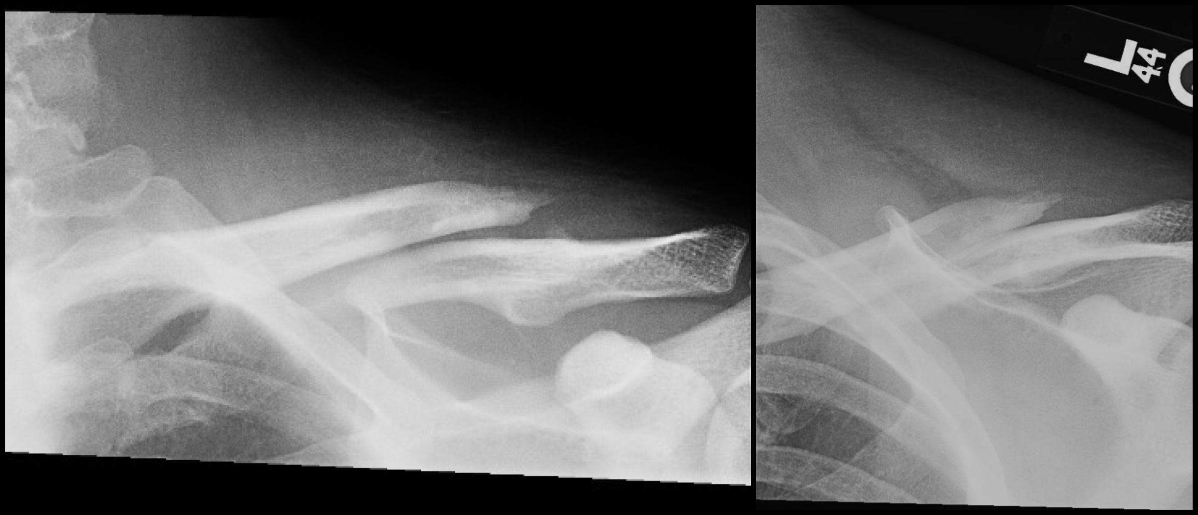 kode icd 10 post orif left clavicle